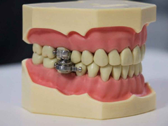 Thiết bị khóa hàm răng cho người muốn giảm cân