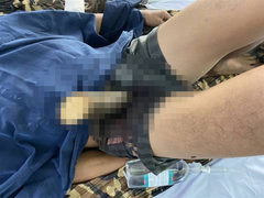 Té trong lúc cưa cây gần bờ sông, người đàn ông bị cọc bần đâm xuyên hạ vị