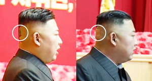 Miếng băng dán y tế trên đầu ông Kim Jong-un gây chú ý
