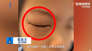 Bé gái mắc chứng bệnh kỳ quái, cứ làm bài tập toán là bị dị ứng