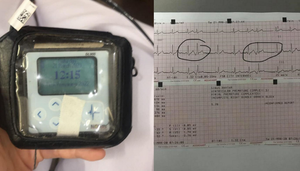 Cô gái bị rối loạn nhịp tim nặng, phải đeo máy theo dõi tim vì... có người yêu