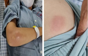 Khó thở, sốt cao, đi khám mới biết nhiễm vi khuẩn Whitmore