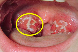 Ung thư vòm họng: Triệu chứng sớm nhất là gì, cách điều trị ra sao?