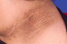 3 dấu hiệu sớm của bệnh tiểu đường: Chỉ cần thấy 1 triệu chứng là phải khám ngay