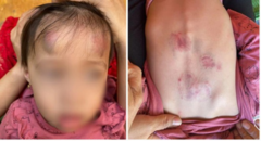 Bé gái 2 tuổi bị bạn đánh thâm tím: Cô giáo không biết, dân mạng phẫn nộ