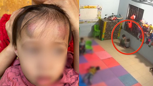 Bé gái 2 tuổi ở Bắc Giang bị bạn đánh thâm tím: Đình chỉ cơ sở mầm non