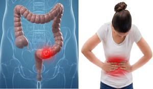 5 triệu chứng sớm của ung thư ruột: Cần khám và điều trị ngay khi thấy nghi ngờ