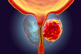 Ung thư tuyến tiền liệt: Các dấu hiệu cảnh báo sớm nhất bạn cần gặp bác sĩ ngay