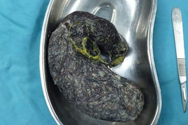 Phẫu thuật lấy búi tóc nặng nửa ký trong dạ dày bé gái 7 tuổi