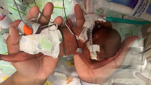 Em bé sinh non nhất thế giới sống sót diệu kỳ dù chỉ có 1% cơ hội