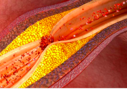 5 dấu hiệu cảnh báo mạch máu bị tắc nghẽn: Nên đi khám ngay khi vừa phát hiện