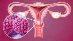 Bác sĩ tiết lộ 11 quan niệm sai lầm về virus HPV: Bạn có thể cũng đang hiểu sai