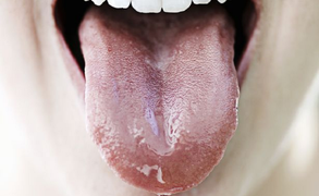 12 dấu hiệu cảnh báo trên lưỡi không nên bỏ qua: Bao gồm cả triệu chứng COVID-19