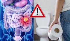 Dấu hiệu khi đi đại tiện cảnh báo bệnh ung thư đại trực tràng, cần đi khám ngay