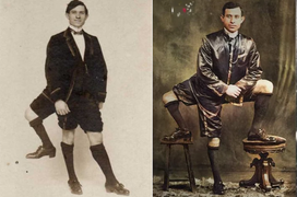 Người đàn ông ‘mọc thừa’ chân thứ 3, tưởng bất hạnh mà lại kiếm được bộn tiền