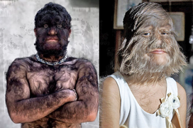 'Người sói’ ngoài đời thực - hội chứng kỳ dị bậc nhất mà y học chưa thể lý giải