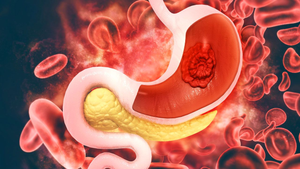 Dấu hiệu sau bữa ăn cảnh báo ung thư dạ dày