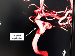 Cảnh giác nguy cơ bệnh lý nặng khi bị đau đầu kéo dài