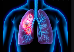 5 loại 'khí' làm tăng nguy cơ ung thư phổi: Muốn ngăn ngừa bệnh thì nên tránh xa