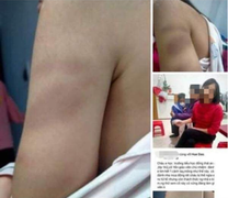 Cô giáo dùng thước đánh tím tay học sinh lớp 1 ở Hải Phòng: Thông tin mới nhất 