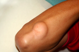 3 yếu tố gây ra bệnh u mỡ: Cách phát hiện để xử lý sớm, ngăn ngừa tiến triển