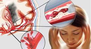 4 thói quen dễ gây tắc nghẽn mạch máu não 