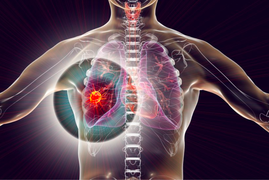 4 kiểu ho cảnh báo bệnh ung thư phổi: Đừng nhầm lẫn với các cơn ho thông thường