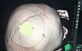 Sức khoẻ bé gái 3 tuổi ở Hà Nội bị đinh ghim vào đầu hiện thế nào?