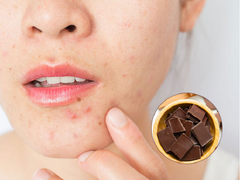 7 tác dụng phụ của Sô-cô-la có thể bạn chưa biết: Ngày Valentine càng phải chú ý