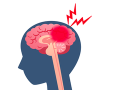 8 dấu hiệu của bệnh xuất huyết não: Ghi nhớ để xử lý sớm có thể cứu sống bạn