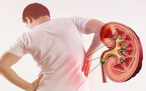Sỏi thận: Ghi nhớ nguyên nhân, dấu hiệu và cách loại bỏ sỏi để phòng bệnh từ gốc