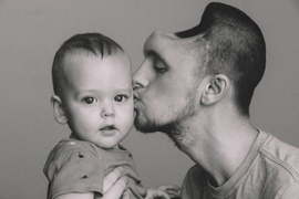 Chàng trai đột ngột phải cắt bỏ nửa bộ não, lý do bởi 1 thói quen rất phổ biến