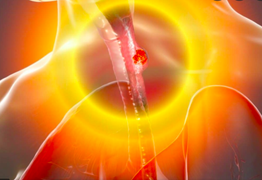 4 nhóm người có nguy cơ mắc ung thư thực quản: Nên biết sớm để ngừa rủi ro