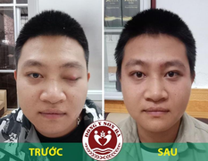 Địa chỉ chữa sụp mí mắt bằng Đông y hiệu quả