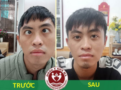 Phương pháp chữa lác mắt hiệu quả bằng Đông y