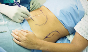 Không xác định được nguyên nhân người phụ nữ tử vong do hút mỡ bụng