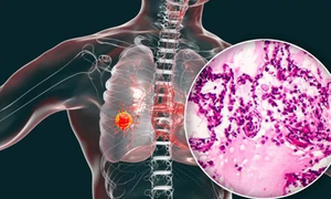 Cơn ho thế nào là dấu hiệu ung thư phổi: Cách phân biệt với bệnh thông thường