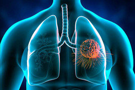 Một tháng ho khan, đi khám phát hiện ung thư giai đoạn cuối