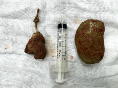 Viên sỏi to hơn quả trứng gà trong bàng quang của nam thanh niên 27 tuổi