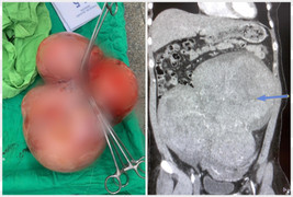 Nữ bệnh nhân 35 tuổi có khối u xơ tử cung nặng 5,5kg