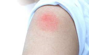 Hiện tượng 'cánh tay COVID' sau tiêm vaccine ở trẻ: Cha mẹ cần nhớ điều này