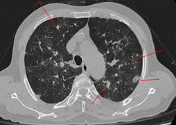 Phổi đông đặc sau 20 ngày khỏi COVID-19