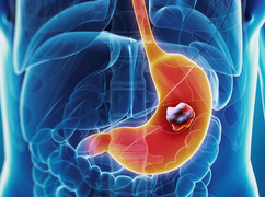 Không phải đau bụng, đây mới là 8 dấu hiệu sớm cần chú ý của bệnh ung thư dạ dày