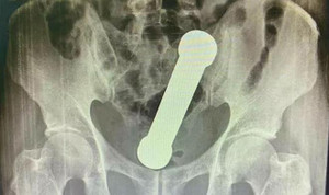 Quả tạ 2 kg mắc kẹt trong trực tràng người đàn ông khiến bác sĩ choáng váng