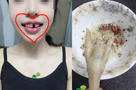 Cô gái gãy mất răng vì chân gà, đọc đến bình luận của dân mạng còn hết hồn hơn