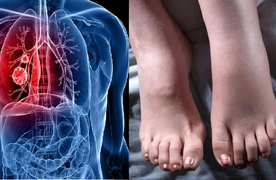 4 dấu hiệu ở chân cảnh báo phổi đang gặp vấn đề nguy hiểm cần phải thăm khám sớm