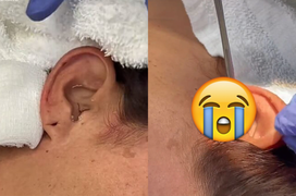 Đang ngủ bỗng thấy đau tai, cô gái kinh hãi khi thấy ‘vật lạ’ lòi ra