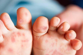 Bệnh tay chân miệng và sốt xuất huyết tăng mạnh ở TP.HCM, 6 ca tử vong