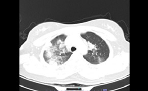 Cô gái 18 tuổi bị viêm phổi nặng sau một tháng khỏi COVID-19 