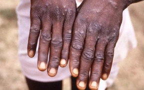 Các nước 'đổ xô' tích trữ vaccine đậu mùa khỉ